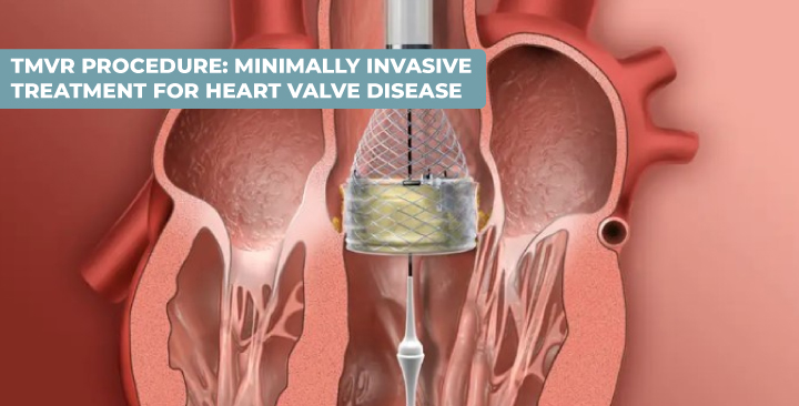 TMVR Procedure: Minimally Invasive Treatment for Heart Valve Disease