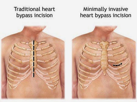 MINIMAL INVASIVE CARDIAC SURGERIES