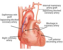 Coronary Artery Bypass Grafting